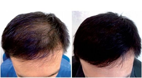 Homeuse LLLT Wavelength Laser Therapy Cap 272 Diodes For Hair Loss