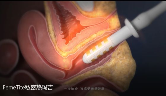 New Technology Radio Frequency Non-surgical Therapy Vaginal Rejuvenation For Clinical