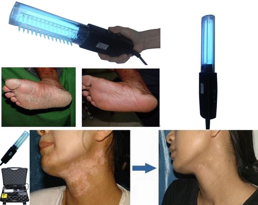 Portable 311nm Uvb Phototherapy Lamp 250V Vitiligo Lamp Treatment